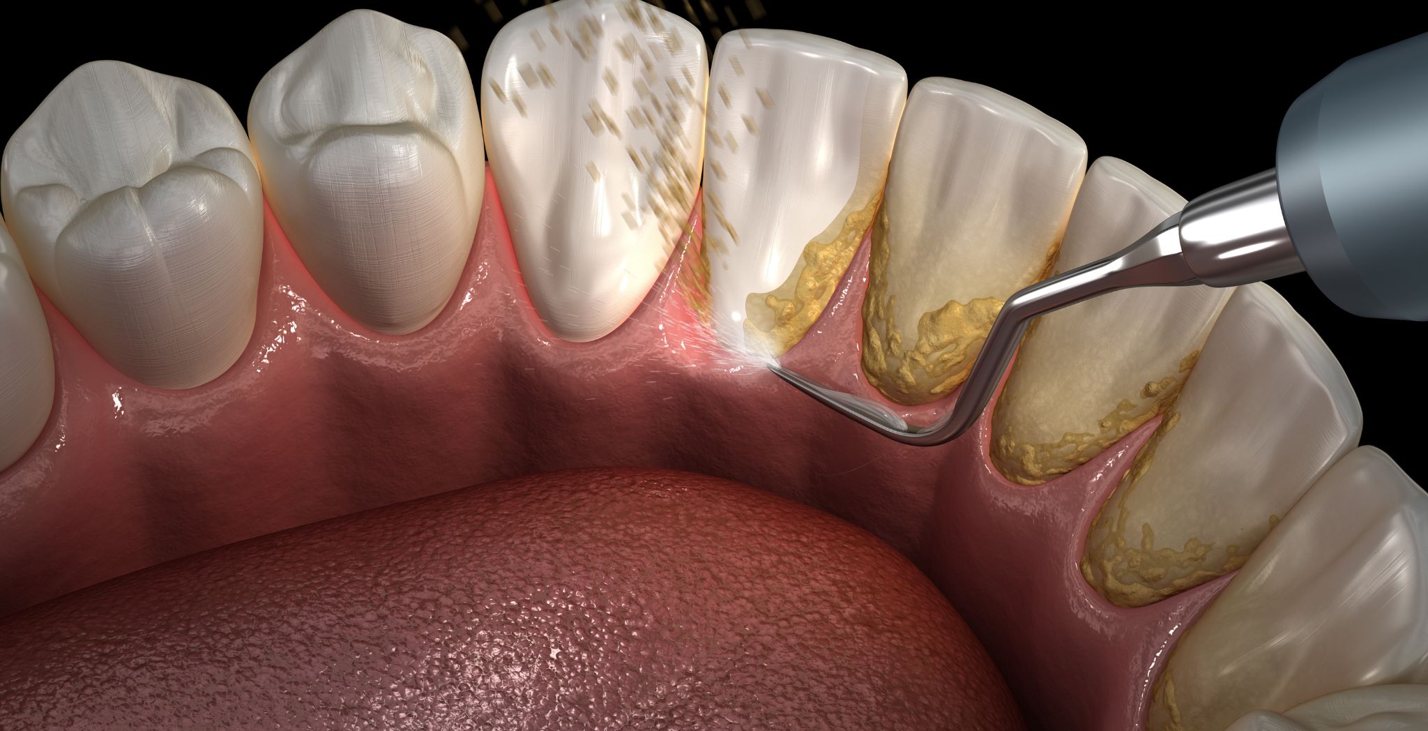 Dental Plaque vs Calculus
