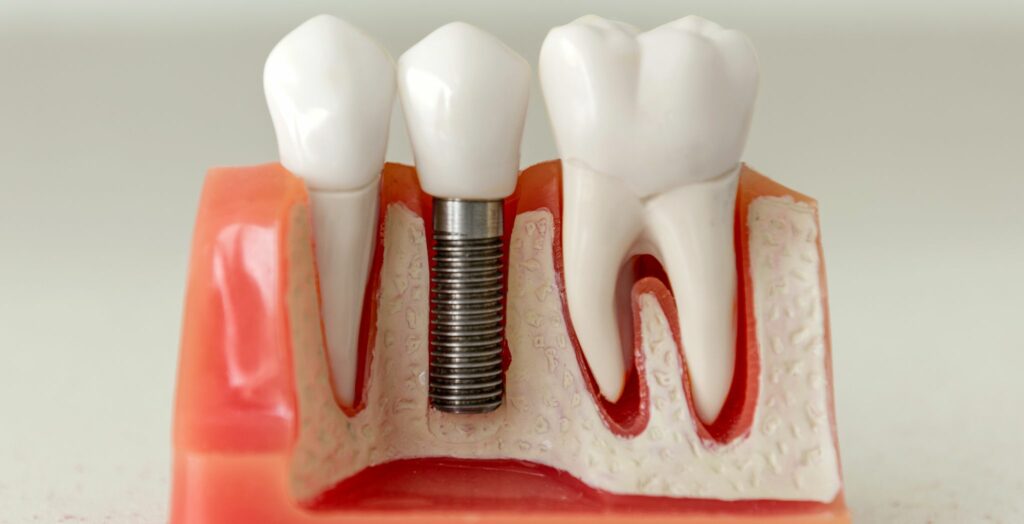 Bone graft for dental implant, Dental bone graft procedure, Bone grafting before implants, Types of dental bone grafts, Bone graft recovery for implants