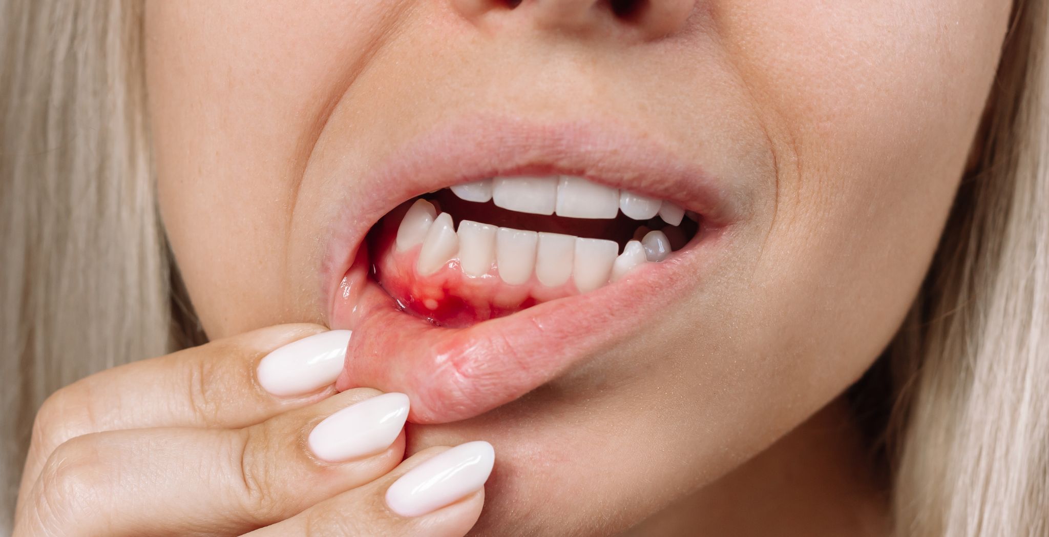 Types of gum disease, Gingivitis and periodontitis, Stages of gum disease, Common gum infections, Gum disease symptoms, Advanced gum disease, Mild gum disease treatment, Severe gum disease,